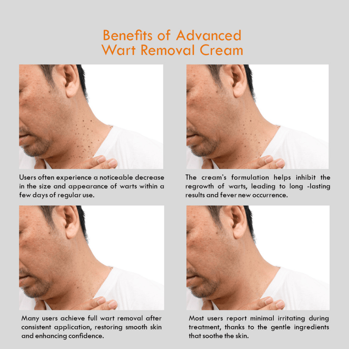 D-Fame Advanced Wart Removal Cream – Fast Results